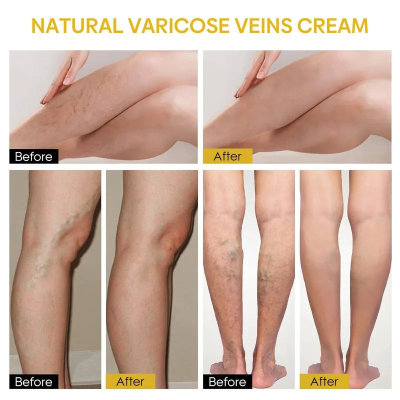 Bee Venom Leg Pain and Swelling Cream